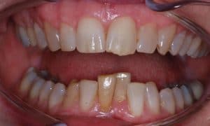 Dental treatment before