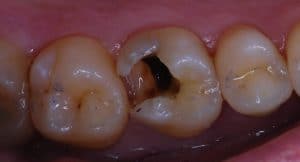 Tooth decay - before treatment