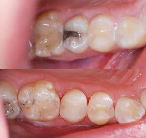 Before_After White dental filling
