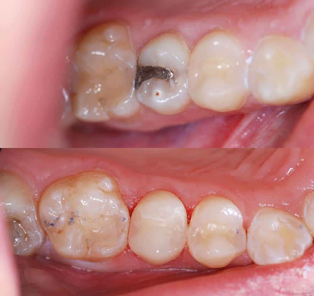 Restorative Dentistry Tooth Filling Image