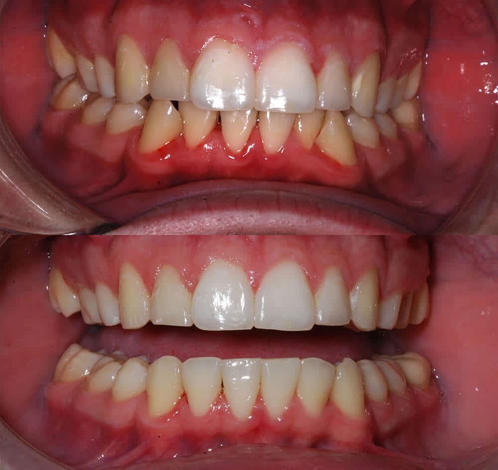 Invisalign Before and After Image 11