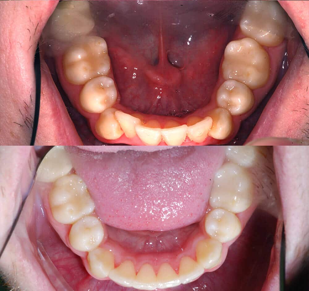 Invisalign Before and After Image 12