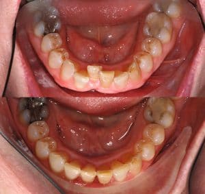 Before and After Photo of Smile Makeover