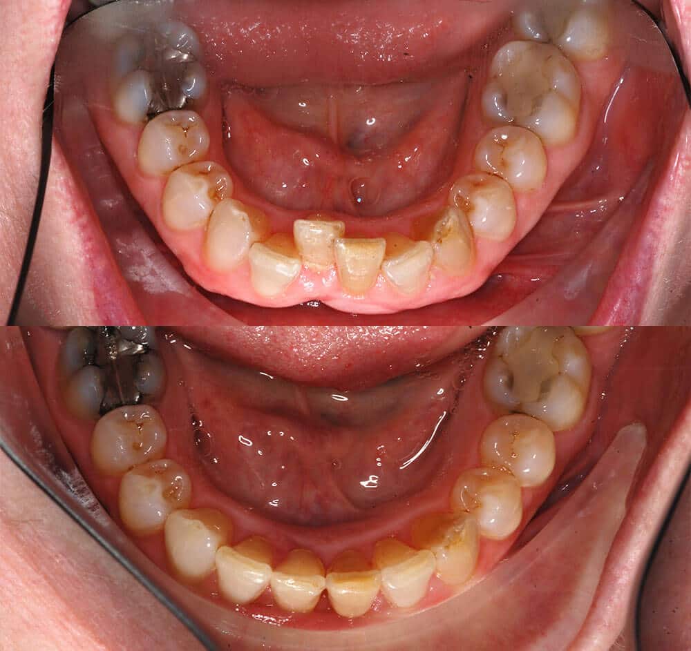 Invisalign Before and After