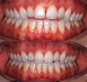 Before and After Photo of Smile Makeover