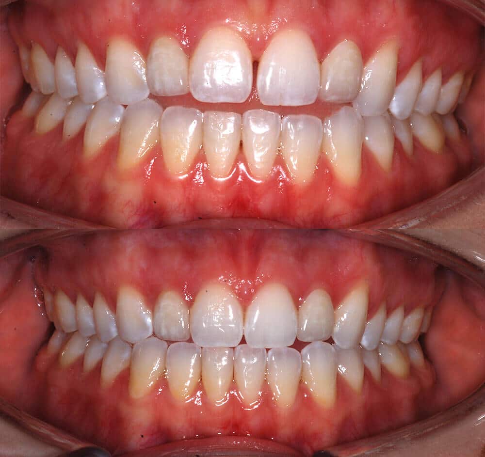 Invisalign Before and After Image 3