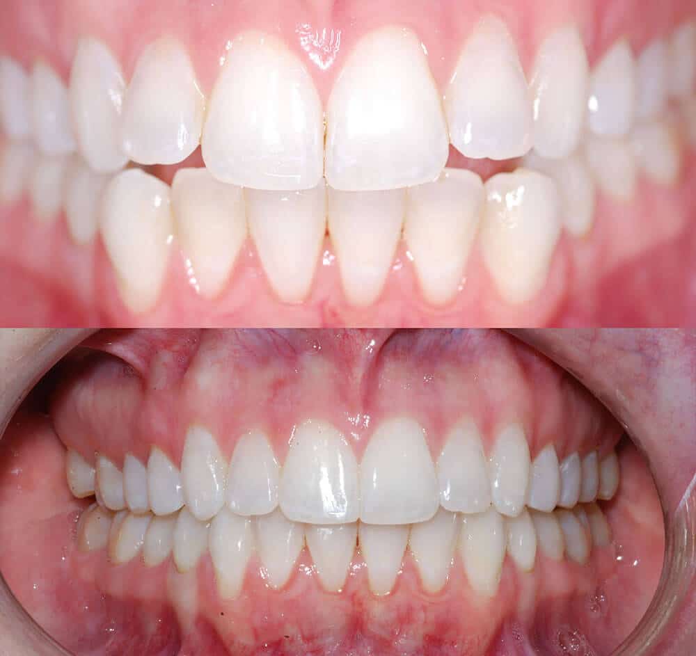 Straight Teeth Before and After