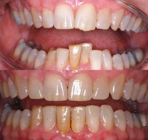 Before and after teeth straightening