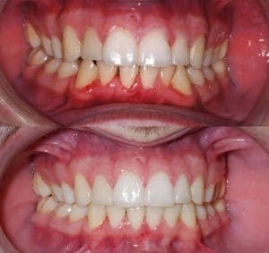 Cosmetic dentistry before and after photos