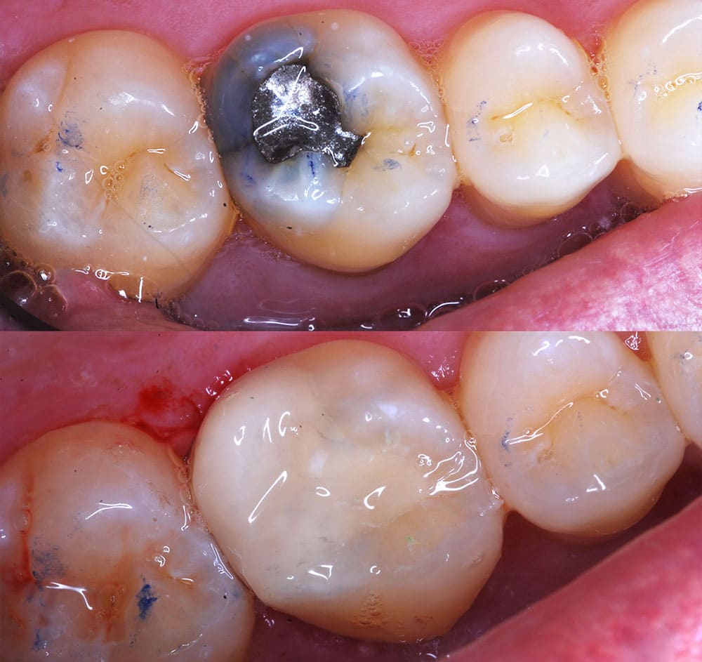 Restorative Dentistry Tooth Filling