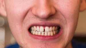 What Are The Options To Fix A Chipped Tooth?