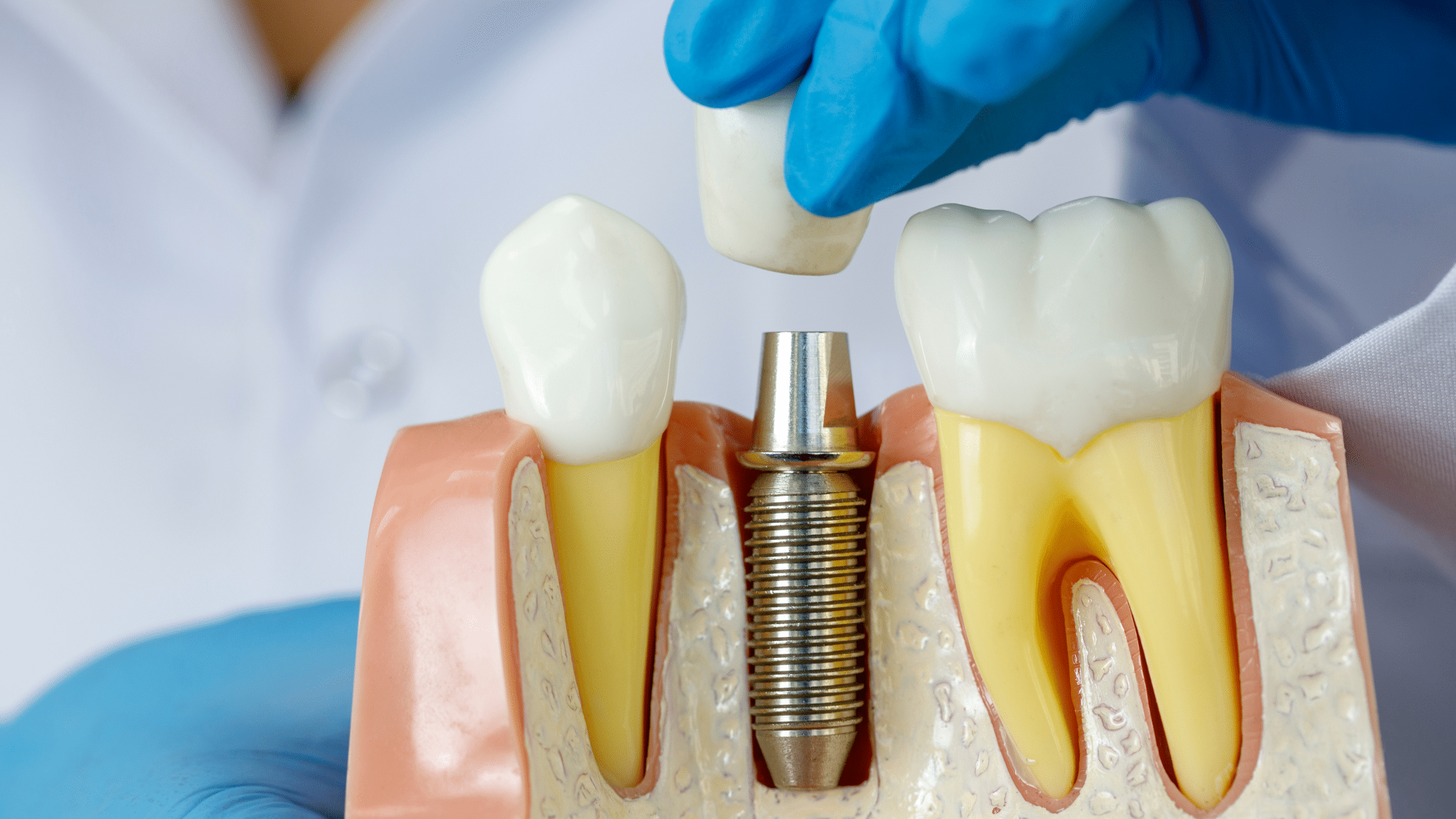 Dental implant in Charlotte, NC