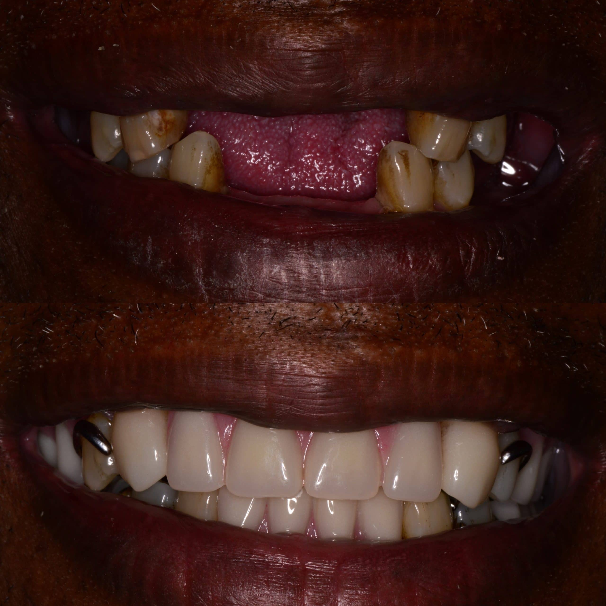 Tooth replacement before and after image