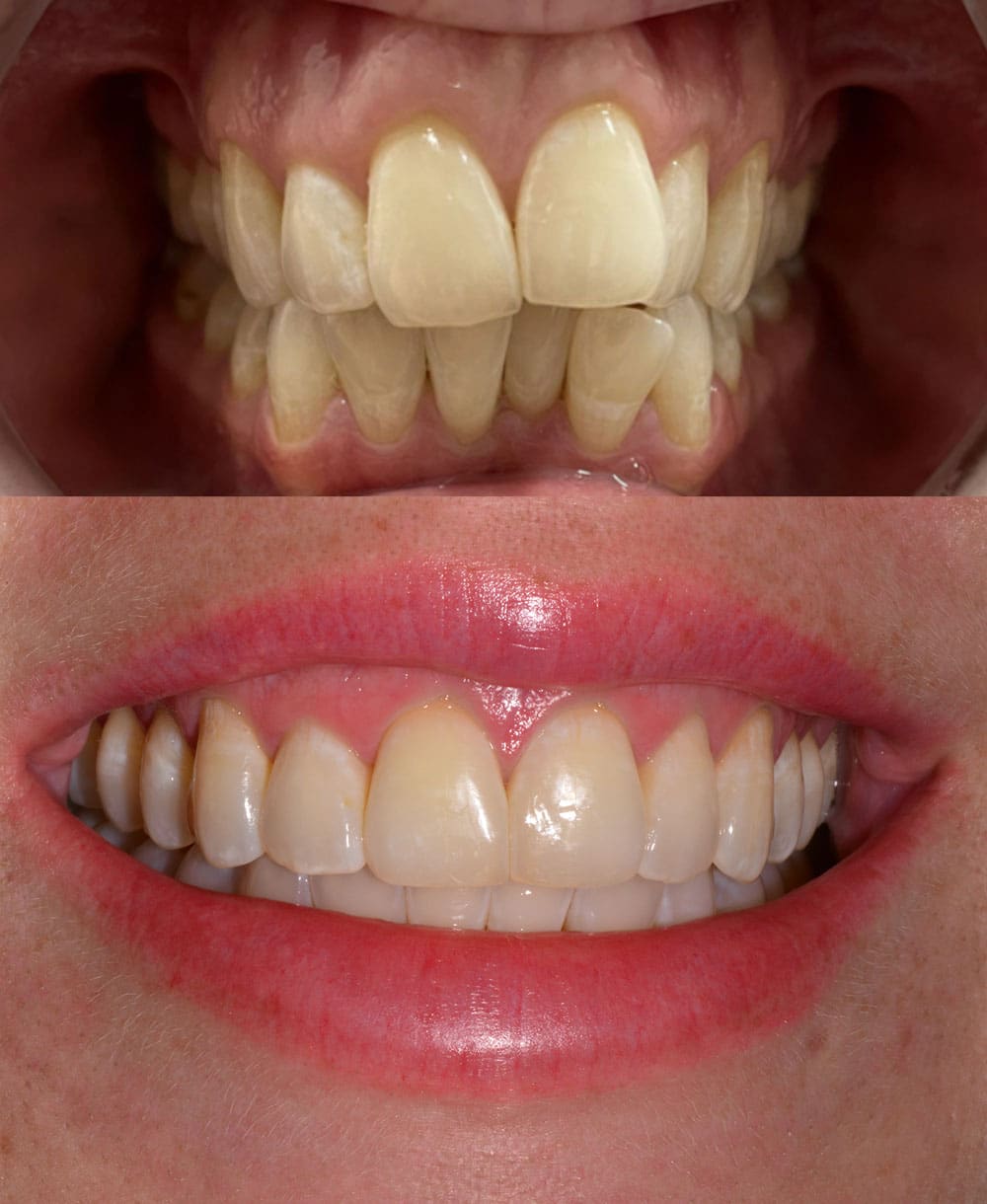 Teeth Straightening Before and After Images