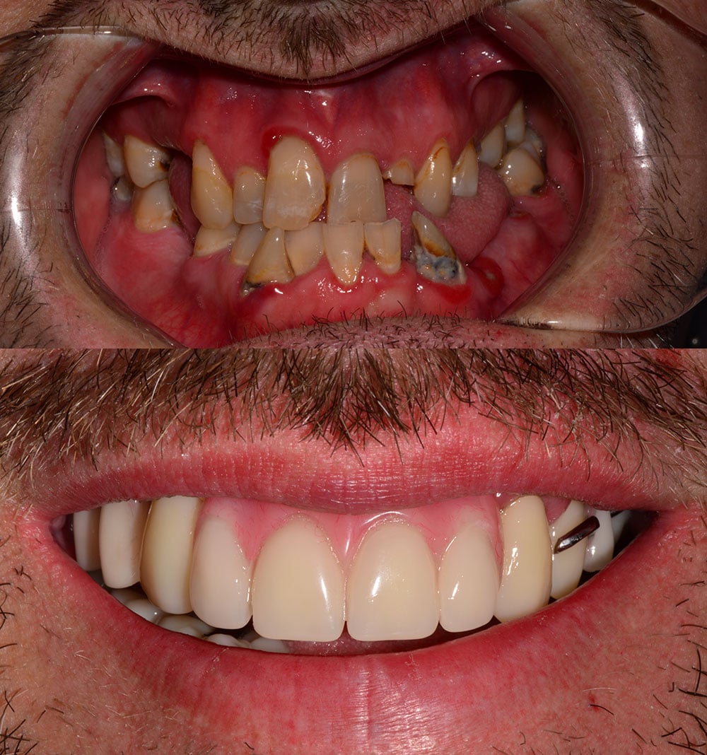 Smile Design before and after image