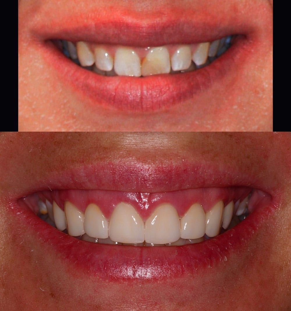 Restorative Dentistry Tooth Filling