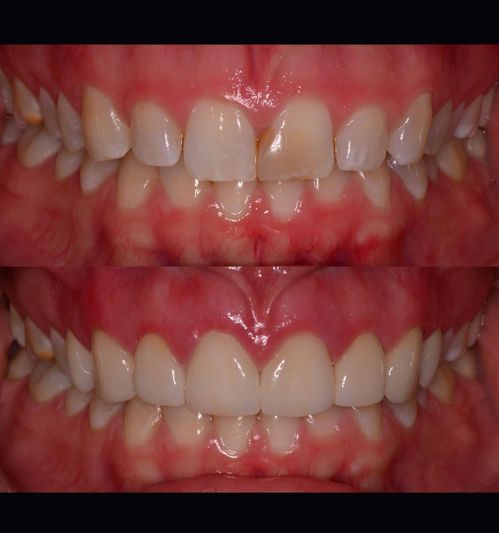 Restorative Dentistry Tooth Filling Image