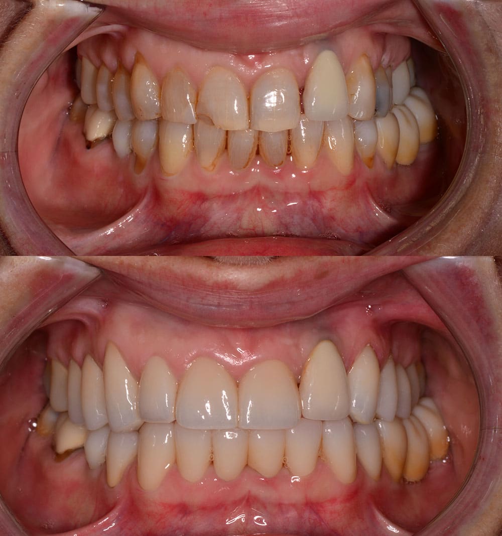 Tooth replacement before and after image