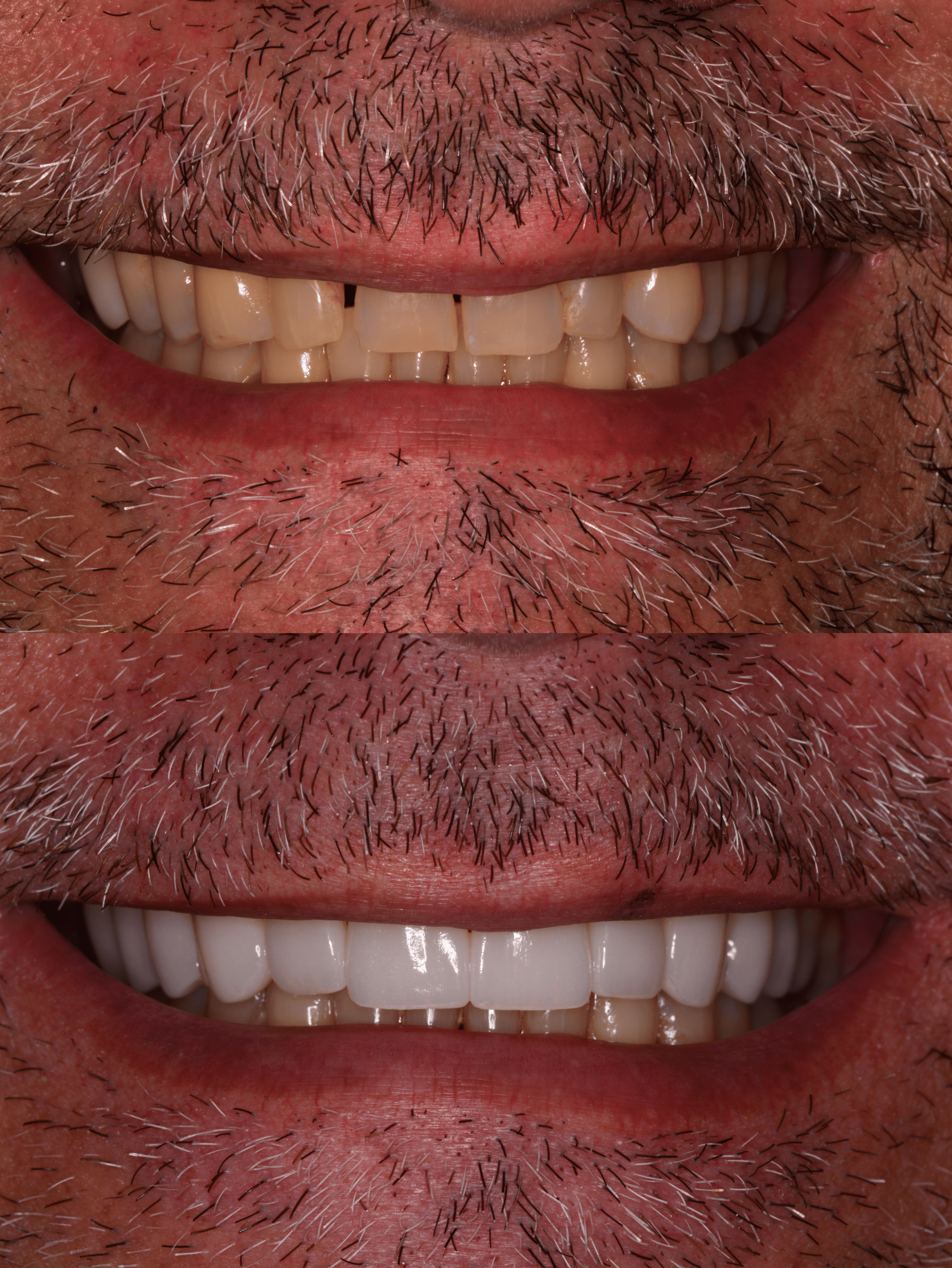 Smile Design before and after image