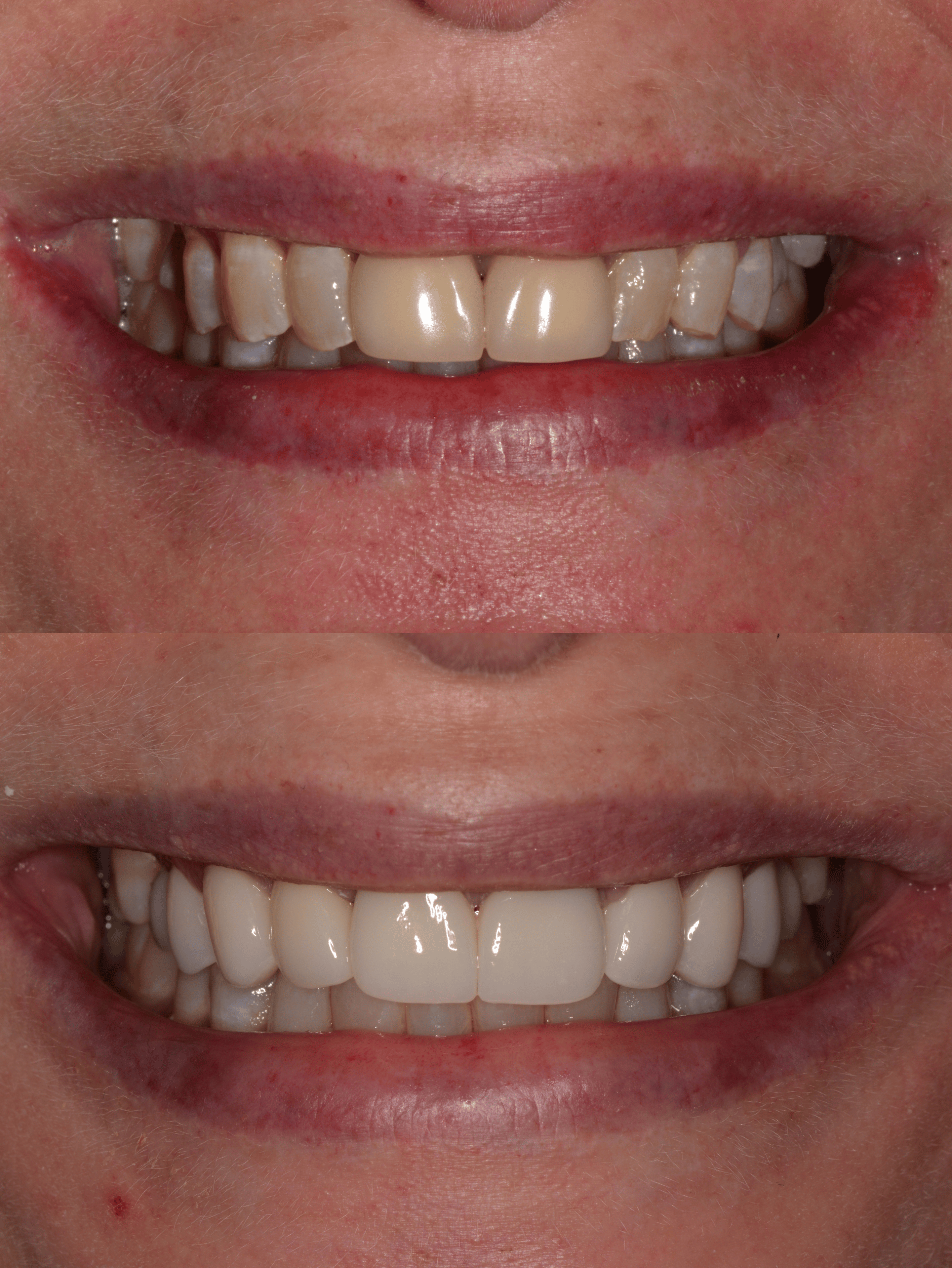Dental Implant Restoration Before and After